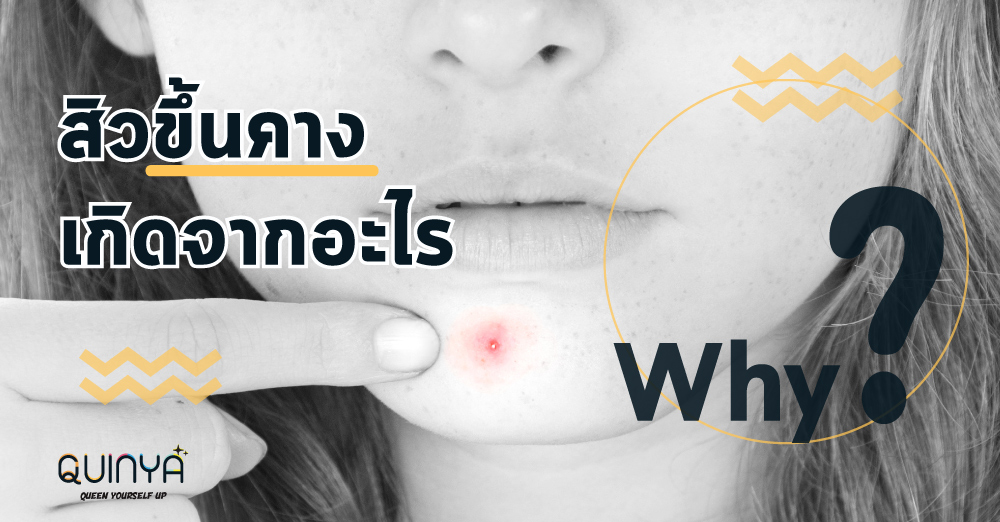 สิวขึ้นคางเกิดจากอะไร..?